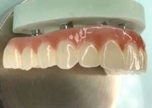 Prótese Dentária em Zircônia Dental