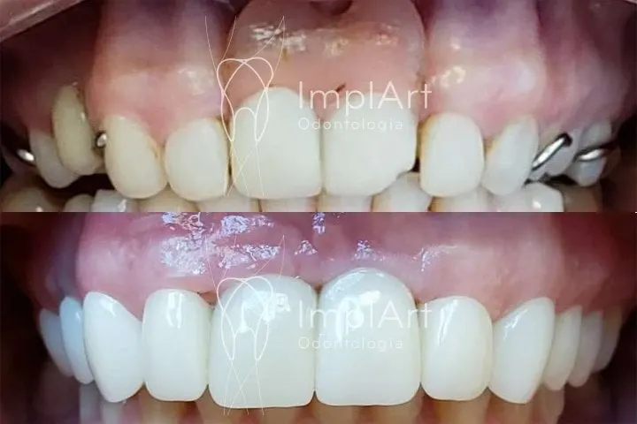COROA DE ZIRCONIA SOBRE IMPLANTES