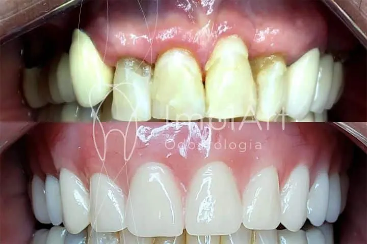 PRÓTESE PROTOCOLO SOBRE IMPLANTES