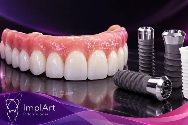 implantes na clinica implart