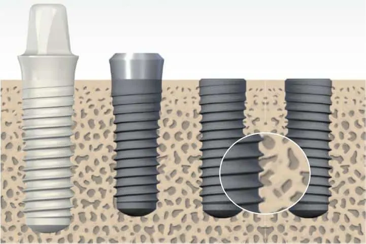 implante osseointegração clinica odontologica ImplArt clinica especialista em implantes