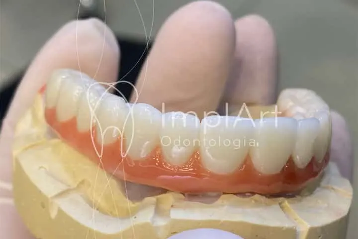 PROTESE PROTOCOLO SOBRE IMPLANTES ZIRCONIA