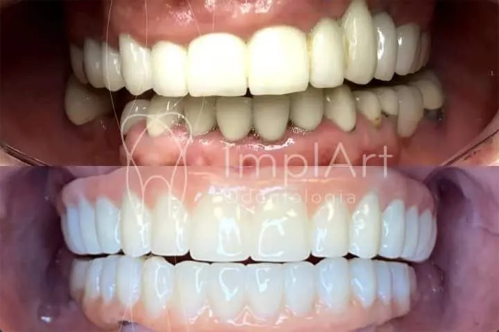 foto de prótese protocolo em zirconia sobre implantes